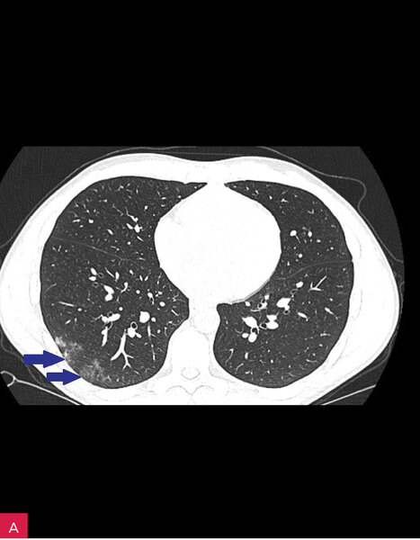 Rycina 5A i B. Ocena pulmonologiczna. A. Badanie tomografii komputerowej klatki piersiowej wysokiej rozdzielczości. W płucu prawym przy tylnej ścianie klatki piersiowej widoczne położone obwodowo obszary matowej szyby (niebieskie strzałki). B. Badanie ultrasonograficzne płuc przy użyciu głowicy liniowej. Widoczne pogrubienie linii opłucnej i jej ubytek (czerwona strzałka) oraz niewielka podopłucnowa konsolidacja z towarzyszącą linią C typu ogon komety (comet tail; zielona strzałka)