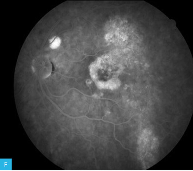 Rycina 7A-F. Angiografia fluoresceinowa dna oka lewego. Obrazy w górnym rzędzie przedstawiają angiogram od fazy tętniczej przez fazę tętniczo-żylną do fazy żylnej