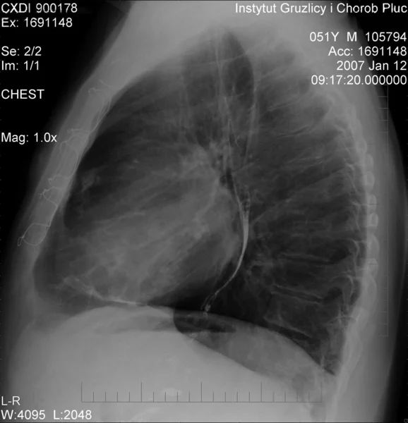 Rycina 1. Badanie radiologiczne klatki piersiowej w projekcji bocznej. Stan po częściowej perikardiektomii u chorego z zaciskającym zapaleniem osierdzia o etiologii gruźliczej.