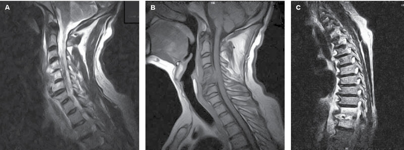 Rycina 1. (A, B) Zmiany o typie spondylodiscitis obejmujące trzony kręgów i przestrzenie międzykręgowe C4-C5, C5-C6 oraz towarzyszący ropień przykręgosłupowy na wysokości C4-C5. (C) Spondylodiscitis na wysokości Th11-Th12.