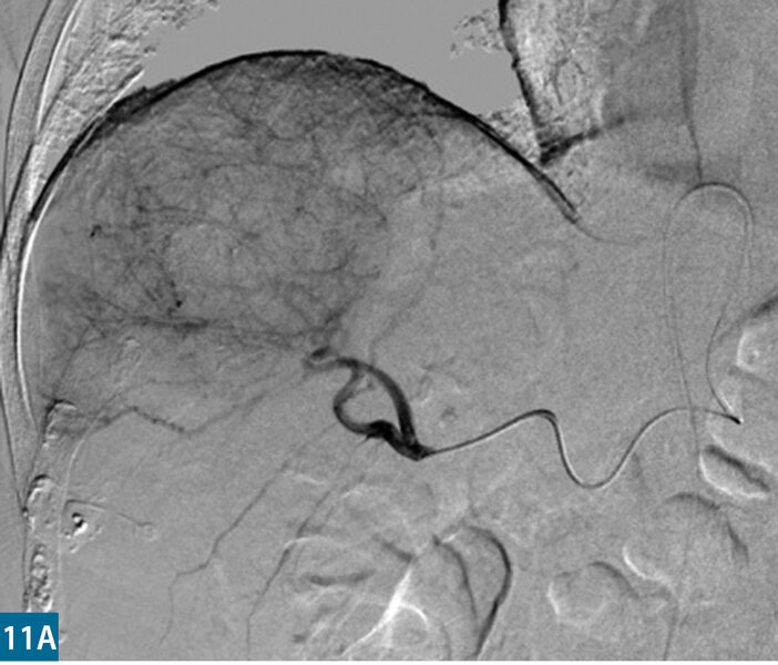 Rycina 11. Arteriografia przed TACE (A) i po TACE (B)