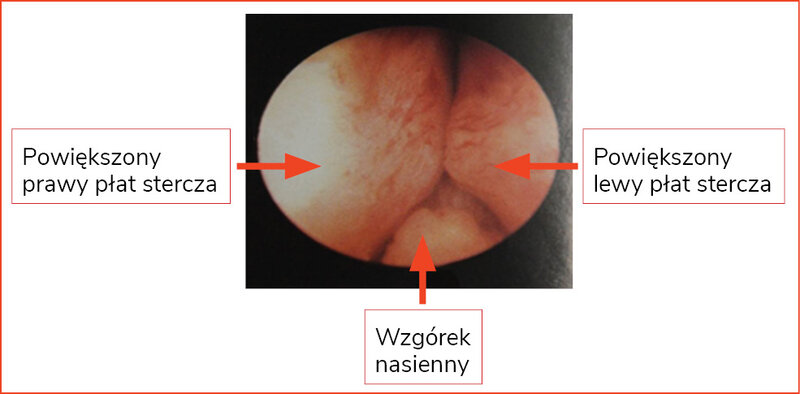 Rycina 2. Obraz endoskopowy przerośniętych płatów gruczołu krokowego (widok na wysokości wzgórka nasiennego)