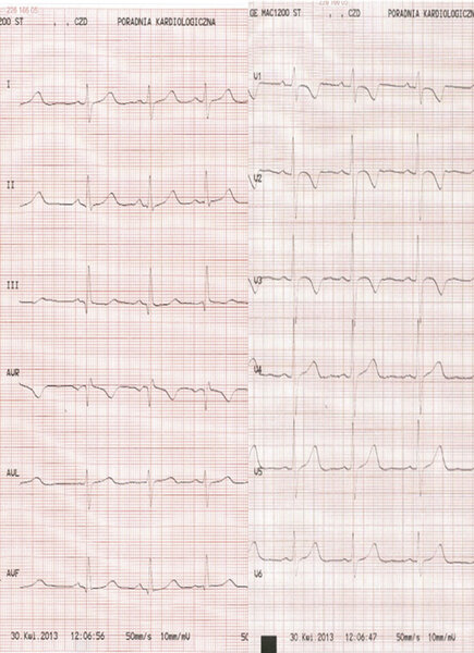 Rycina 6. EKG dziecka 3-letniego.