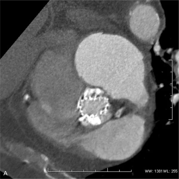 Rycina 5. Zastawka biologiczna CoreValve™ w ujściu aortalnym w przekroju poprzecznym i podłużnym.