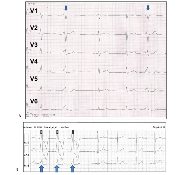 Rycina 8. Siedemnastoletnia tancerka zawodowa (12 lat treningów). (A) EKG spoczynkowy (odprowadzenia przedsercowe) – rytm zatokowy 60/min, czas  PQ 0,14 s, QRS 0,08 s, QT 0,4 s. Zarejestrowano pojedyncze pobudzenia dodatkowe komorowe (PDK – niebieska strzałka) o długim czasie sprzężenia  z pobudzeniem zatokowym w spoczynkowym zapisie EKG. Pierwsze, trzecie i czwarte to pobudzenia zatokowe (wąski zespół QRS), drugie i piąte to PDK (poszerzony zespół QRS). Pobudzenia zatokowe bez cech przerostu z prawidłowym odcinkiem ST-T. PDK o morfologii zbliżonej do obrazu bloku lewej odnogi pęczka Hisa (dominuje ujemna faza zespołu QRS w odprowadzeniach V1-V2 i dodatnia w V3-V6). (B) Zapis holterowski EKG (3-kanałowy, Ch1 – zmodyfikowane komputerowo odprowadzenie przedsercowe V5, Ch2 – zmodyfikowane komputerowo odprowadzenie przedsercowe V1). O godzinie 14:56:40 w czuwaniu  zarejestrowano przyspieszony rytm komorowy 70/min (wolna salwa 3 kolejnych pobudzeń z poszerzonym zespołem QRS na początku zapisu, oznaczonych symbolem T – trzy strzalki), przechodzący w wolny rytm zatokowy 60/min (4 ostatnie zespoły QRS).