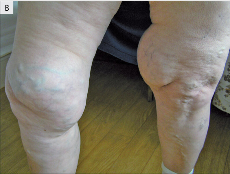 Rycina 7 A i B. Lipoedema.