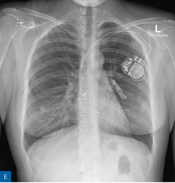 Rycina 1. Obraz radiologiczny w procesie identyfikacji kardiologicznego urządzenia wszczepialnego (CIED). A. Rozrusznik dwujamowy. B. Kardiowerter-defibrylator dwujamowy. C. Kardiowerter-defibrylator podskórny. D. Urządzenie do terapii resynchronizującej z funkcją defibrylacji E. Pętlowy rejestrator zdarzeń oraz rozrusznik dwujamowy. F. Stymulator bezelektrodowy typu Micra. G. Stymulator bezelektrodowy Abbott AVEIR. H. Układ poprawiający kurczliwość mięśnia sercowego (strona prawa) oraz kardiowerter-defibrylator jednojamowy (strona lewa)
