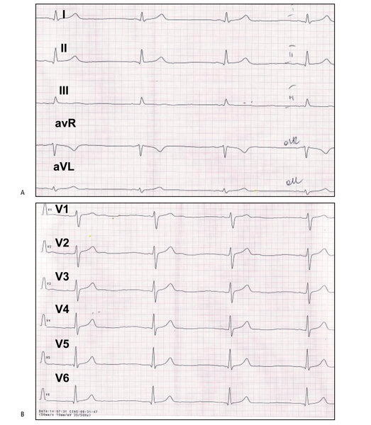 Rycina 1 A i B. Chłopiec w wieku 17 lat, pływak. EKG – normogram, rytm zatokowy (ujemny załamek P w aVR), bradykardia zatokowa 47/min, czas PQ 0,16 s, czas QRS 0,08 s, czas QT 0,42 s. Bez przerostów. Odcinek ST-T w normie. Przesuw papieru 50 mm/s, 1 mV = 10 mm.
