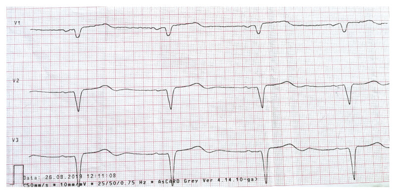 Rycina 2. Elektrokardiogram pacjentki z zawałem mięśnia sercowego bez uniesienia odcinka ST (NSTEMI). Przesuw 50 mm/s. Rytm zatokowy, 60/min, oś pośrednia, cechy martwicy w zakresie ściany przedniej (pacjentka po przebytym OZW-STEMI ściany przedniej), ostry zespół wieńcowy bez uniesienia odcinka ST ściany przedniej, istotne niedokrwienie w obrębie ściany dolnej. Istotne uniesienie odcinka ST w odprowadzeniu aVR – w koronarografii obraz choroby wieńcowej wielonaczyniowej