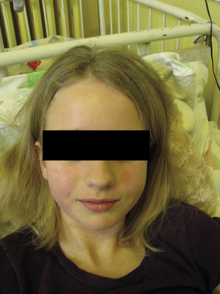 Rycina 3. Rumień twarzy, charakterystyczna bladość wokół ust.