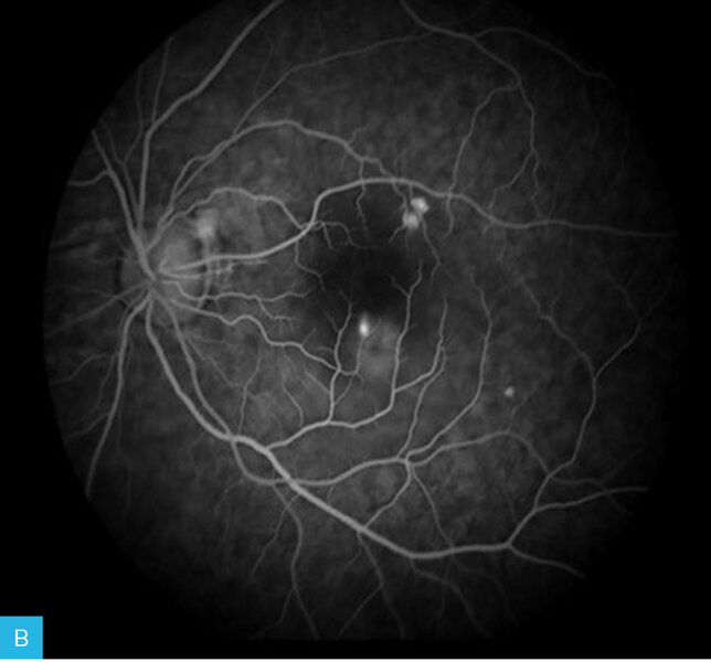 Rycina 13A-F. Angiogram oka lewego