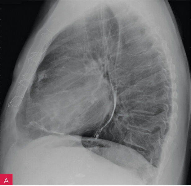 Rycina 5A i B. Badanie radiologiczne klatki piersiowej: zwapnienia w osierdziu