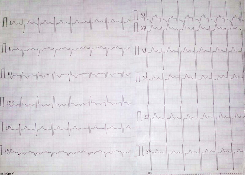 Rycina 1. Zapis EKG.
