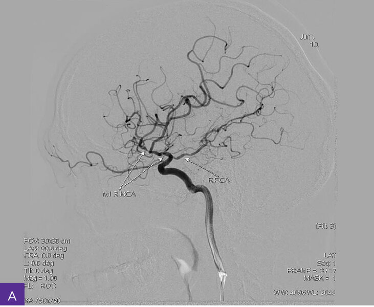 Rycina 4A-C. Cyfrowa angiografia subtrakcyjna (DSA). Widoczna przewlekła niedrożność nadklinowych odcinków obu tętnic szyjnych wewnętrznych, z wzorcem unaczynienia końcowego typu moyamoya, niedrożnością odcinków M1 obu tętnic środkowych mózgu, hipoplazją odcinków A1 obu tętnic przednich mózgu i krążeniem obocznym