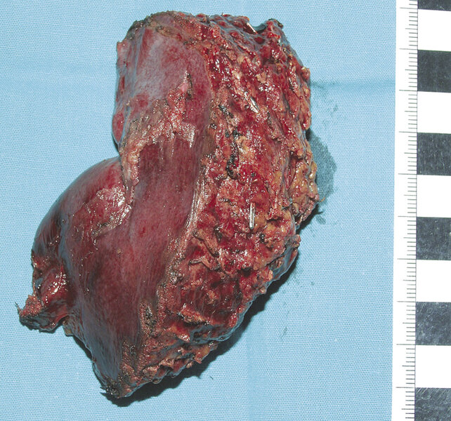 Rycina 2. Wycięty fragment wątroby – loża pęcherzyka żółciowego
