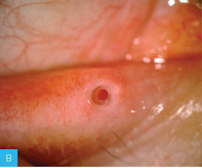 Rycina 1A-C. Leczenie zwężenia punktu łzowego za pomocą implantów perforowanych. A. Stenoza dolnego punktu łzowego. B. Implant perforated plug (firmy FCI) wszczepiony do punktu łzowego. C. Punkt łzowy po usunięciu implantu