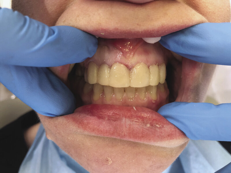 Rycina 4. Po wykonaniu zabiegu gingiwektomii i ustąpieniu krwawienia po usunięciu przerośniętego dziąsła nad koroną zęba 12 osadzono licówki tymczasowe 