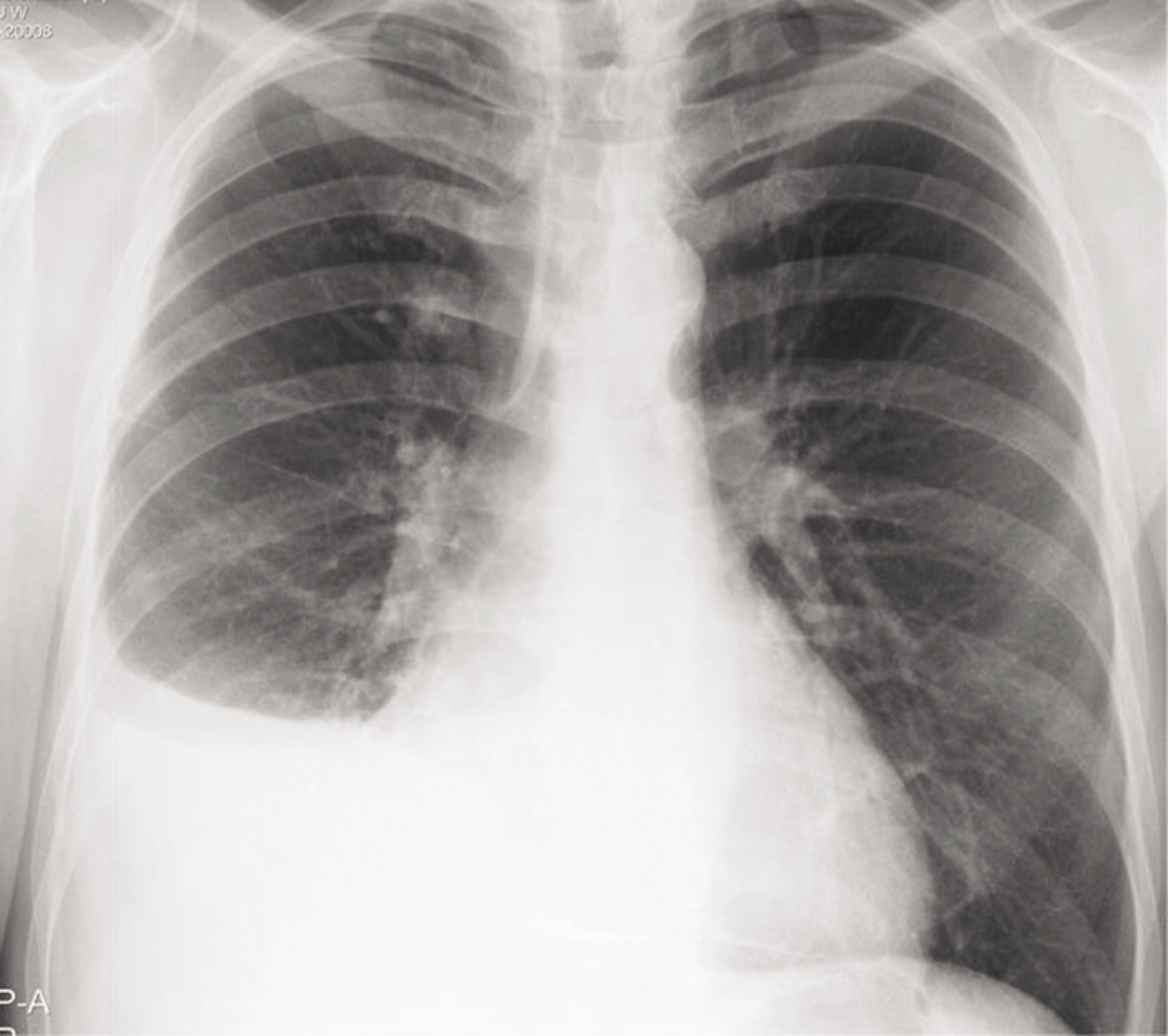 Rycina 6. Badanie radiologiczne klatki piersiowej: płyn w prawej jamie opłucnowej