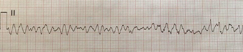 Rycina 1. Migotanie komór w zapisie elektrokardiograficznym