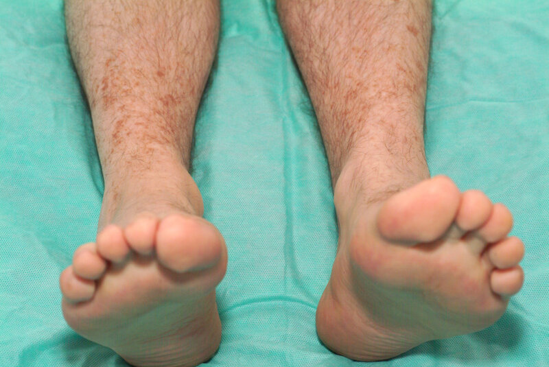 
 
 
 
 Rycina 1. Wysypka na podudziach u&nbsp;pacjenta, którego przypadek opisano w&nbsp;artykule (z&nbsp;archiwum dr. n. med. Macieja Barczyka, Klinika Nefrologii i&nbsp;Transplantologii UMB)