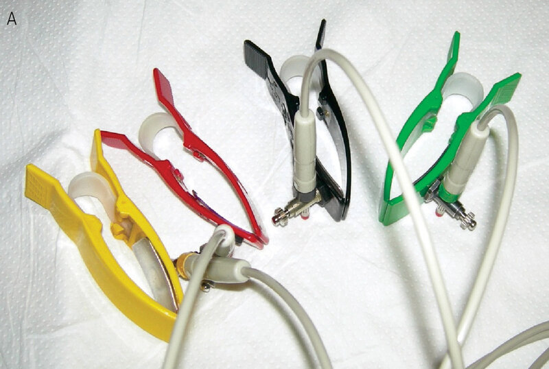 Rycina 1. Elektrody kończynowe (A) i przedsercowe (B) .