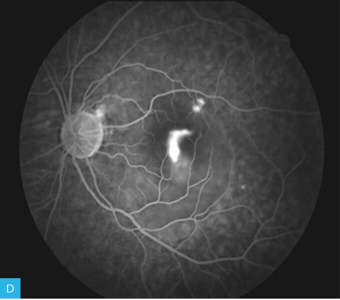 Rycina 13A-F. Angiogram oka lewego