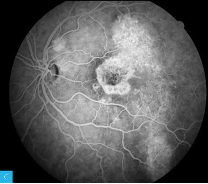 Rycina 7A-F. Angiografia fluoresceinowa dna oka lewego. Obrazy w górnym rzędzie przedstawiają angiogram od fazy tętniczej przez fazę tętniczo-żylną do fazy żylnej