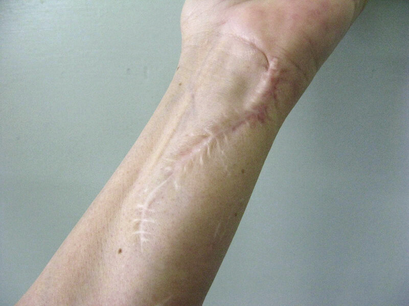 Rycina 3. Keloid w&nbsp;bliźnie po urazie.