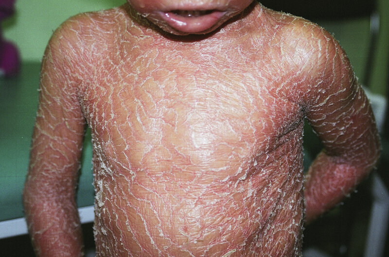 Rycina 9. Erytrodermia w rybiej łusce sprzężona z chromosomem X.