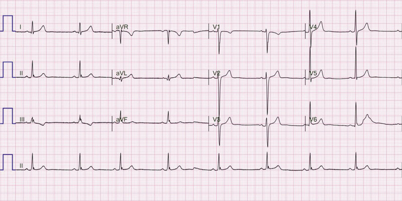 Rycina 2. Zapis 12-odprowadzeniowego EKG 22-letniego pacjenta z arytmogenną kardiomiopatią prawokomorową po przebytym nagłym zatrzymaniu krążenia w mechanizmie migotania komór. Widoczna fragmentacja zespołu QRS w odprowadzeniach znad ściany dolnej. Ponadto iloraz sumy czasu trwania zespołów QRS w odprowadzeniach V1-V3 oraz czasu trwania zespołu QRS w odprowadzeniach V4-V6 wynosi ok. 1,5