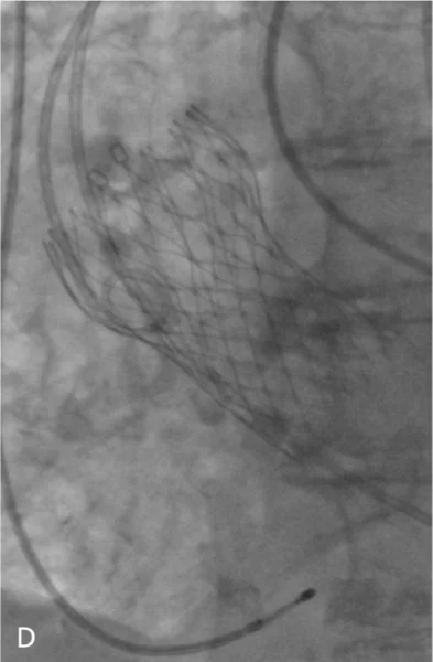 Rycina 3. Kolejne etapy implantacji zastawki CoreValve™.