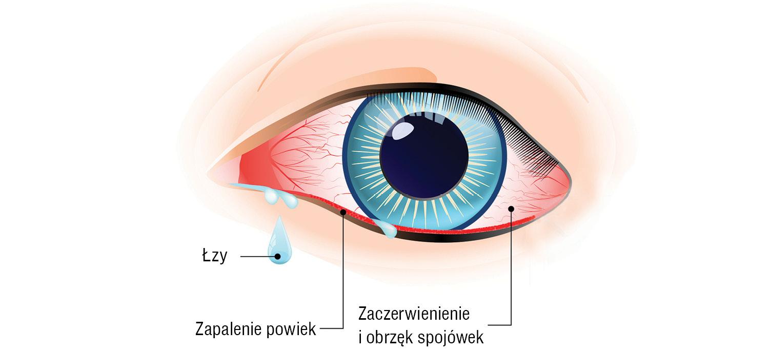 Zapalenie spojówek