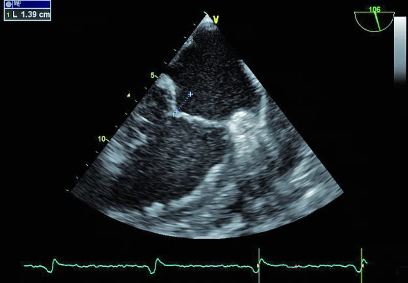 Rycina 6. Prezentacja 2D. Projekcja dolnoprzełykowa dwujamowa.