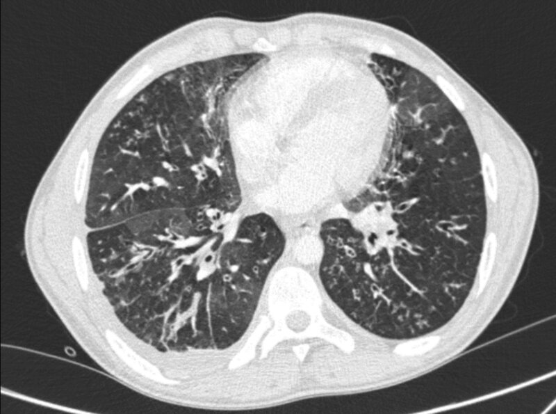 Rycina 2. Skan tomografii komputerowej klatki piersiowej 16-letniego pacjenta z przewlekłym zakażeniem Pseudomonas aeruginosa i Achromobacter xylosoxidans oraz z bardzo zaawansowaną chorobą oskrzelowo-płucną