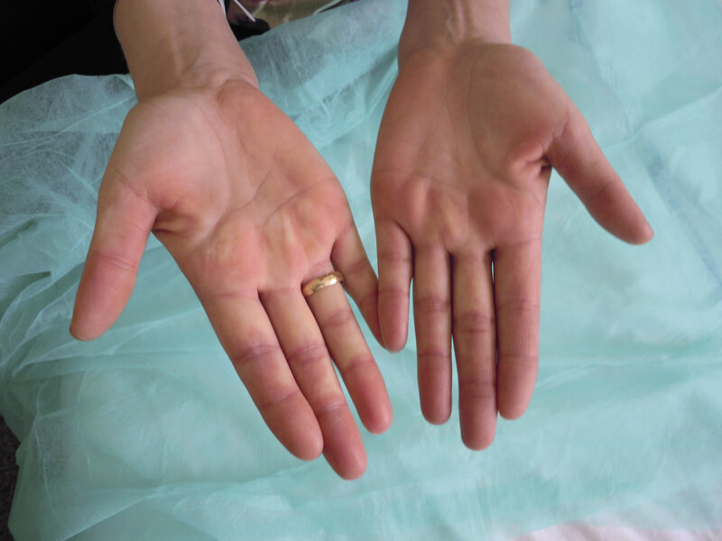 Objaw Raynauda.