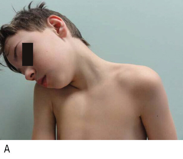 Rycina 1. Typowy wygląd pacjenta z ostrym kręczem szyi (A), przewlekłym kręczem szyi z widocznym napiętym mięśniem mostkowo-obojczykowo-sutkowatym (B) oraz dziecko w gipsie typu Minerwa (C)