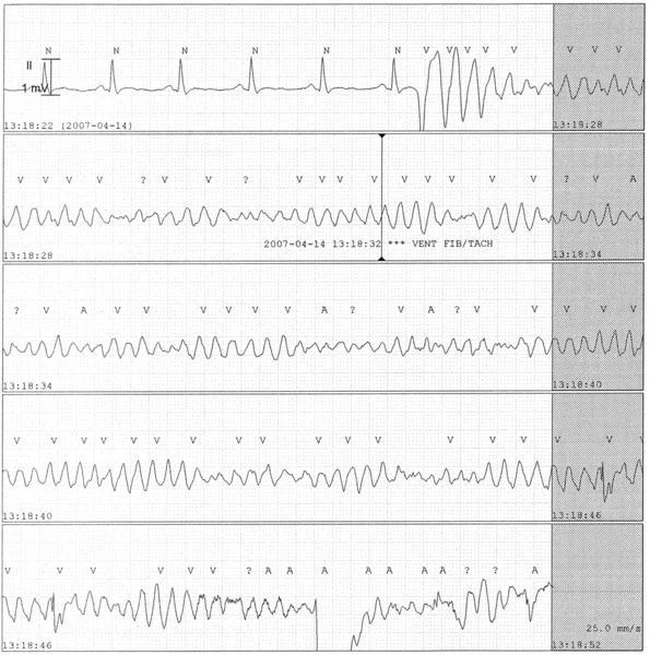  Rycina&nbsp;2. Obraz EKG: zapis ciągły dokonany przez rejestrator przyłóżkowy i&nbsp;przekazany do&nbsp;centrali oddziału intensywnej opieki kardiologicznej
