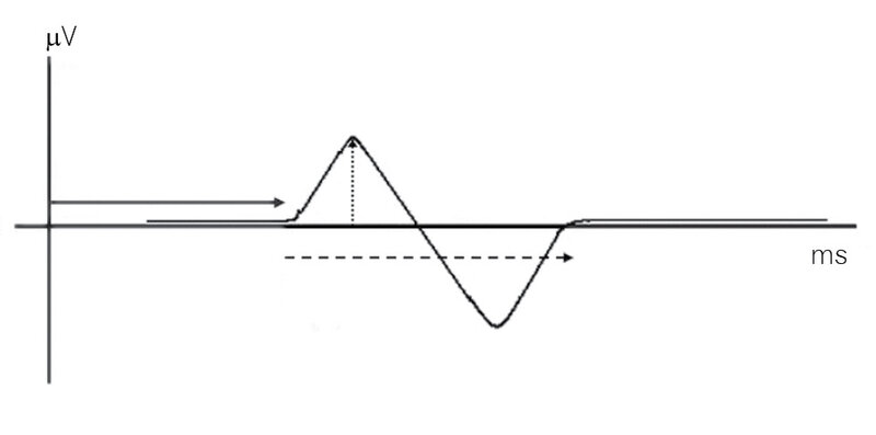 Rycina 3. Parametry potencjału czuciowego.