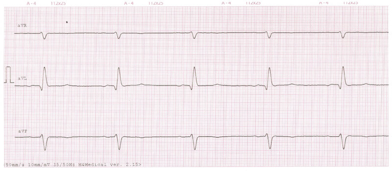 Rycina 1. Elektrokardiogram pacjenta z zawałem mięśnia sercowego z uniesieniem odcinka ST (STEMI) ściany przedniej. Przesuw 50 mm/s. Rytm zatokowy, 63/min, lewogram, blok przedniej wiązki lewej odnogi pęczka Hisa, cechy martwicy w obrębie ściany przedniej, ostry zespół wieńcowy z uniesieniem odcinka ST ściany przedniej (2 doba zawału). W odprowadzeniach V4-V5 pojawiają się ujemne załamki T