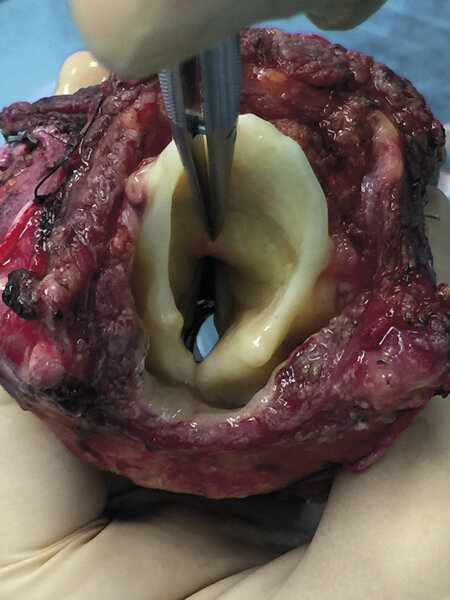 Ryc. 3. Pobrany allotransplant – wnęka tchawicy.