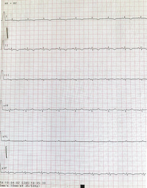 Rycina 9. Badanie EKG, odprowadzenia kończynowe: niska amplituda zespołów QRS