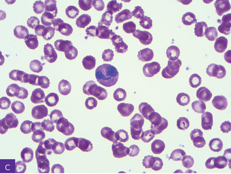 Rycina 10. Ziarnistość toksyczna w granulocytach obojętnochłonnych, wodniczki w monocytach. A. Neutrofil.  B. Monocyt. C. Granulocyt pseudopelgeropodobny