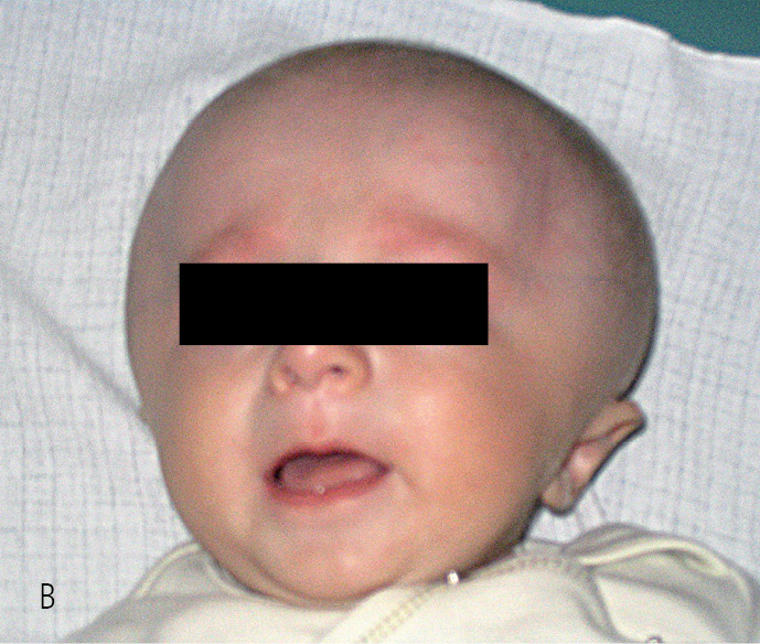 Rycina 11. Deformacja głowy w postaci spłaszczenia przednio-tylnego u małego dziecka (A), powiększona szerokość głowy w wyniku uwypuklenia płatów skroniowych (B) oraz zmniejszenie wymiaru długości głowy u starszego dziecka (C).