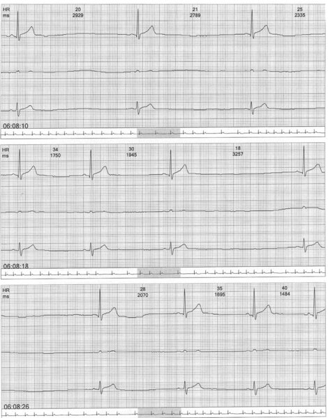 Rycina 4. Fragment trzykanałowego holterowskiego zapisu EKG (przesuw papieru 25 mm/s) 16-letniego chłopca z prawidłową anatomią serca. Zatokowa bradykardia w godzinach rannych, zarejestrowano zahamowanie zatokowe z przerwą RR = 3257 ms (środkowy przykład)