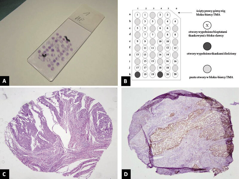 Ryc. 3. A – preparat histologiczny z TMA (H+E), B – przykładowe rozmieszczenie poszczególnych bioptatów w bloku-biorcy,  C + D – dwumilimetrowe bioptaty z tkankami gruczolakoraka 