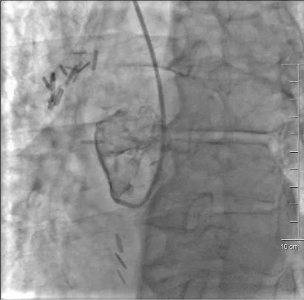 Rycina 2. Angiogram opuszki aorty – nie uwidoczniono odejścia prawej tętnicy wieńcowej.