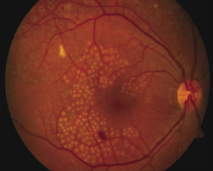 
 
 
 
 Rycina 3. Laseroterapia plamki