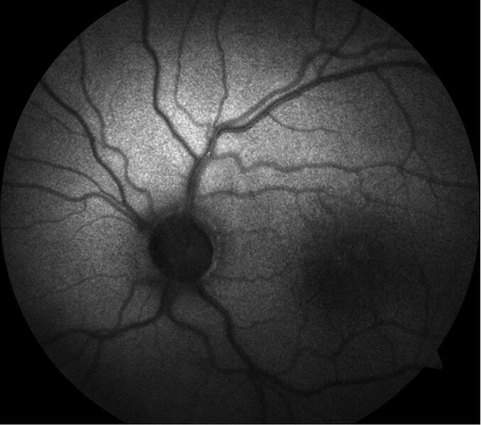 Rycina 3. Hipoautofluorescencja w obrębie dołka plamki