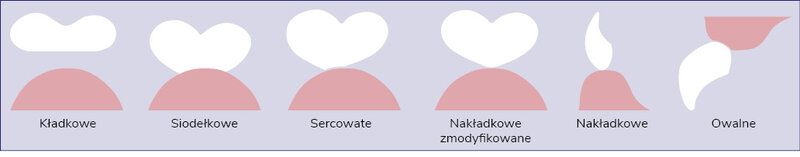 Rycina 1. Przekroje przęseł w mostach protetycznych (opracowanie własne)