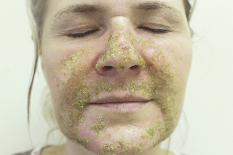 Rycina 1. Impetiginizacja. Żółtomiodowe strupy na skórze twarzy